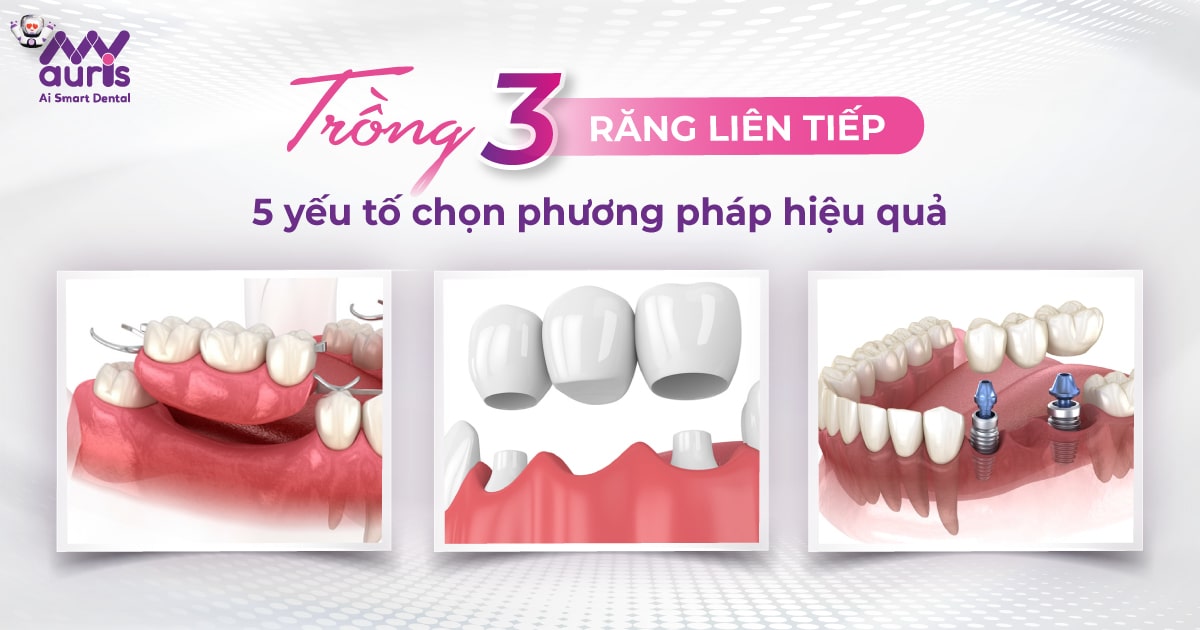 Trồng 3 răng liên tiếp