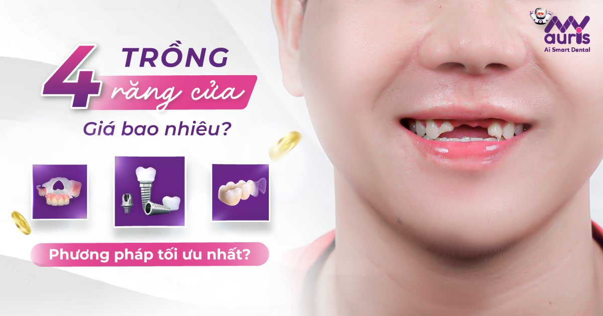 Trồng 4 răng cửa giá bao nhiêu