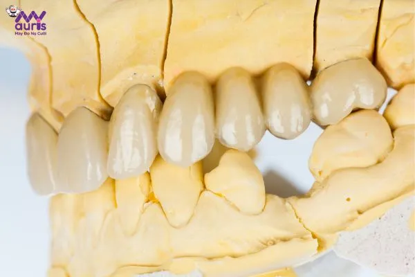 Trường hợp nào trồng răng bằng cầu răng sứ?