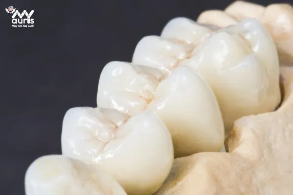 Ưu nhược điểm của trồng răng bằng cầu răng sứ 