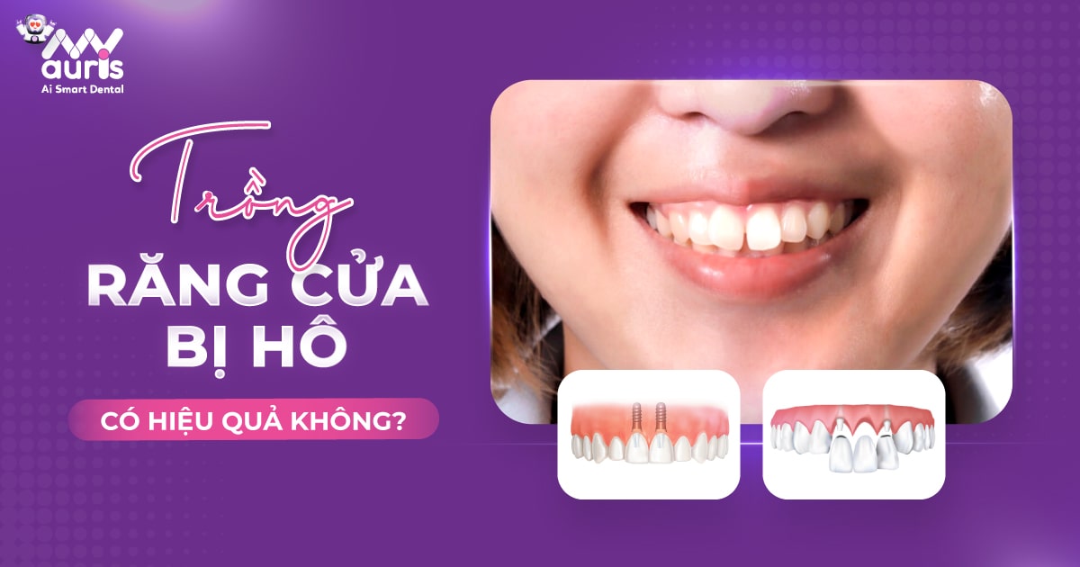 Trồng răng cửa bị hô có hiệu quả không?