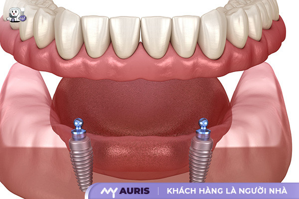 trồng răng giả tháo lắp,làm răng giả tháo lắp