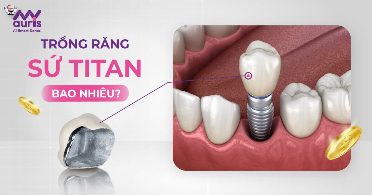 Trồng răng sứ Titan giá bao nhiêu? - 6 yếu tố ảnh hưởng