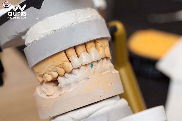 Tuổi thọ của răng sứ Cercon sử dụng được trong bao lâu?
