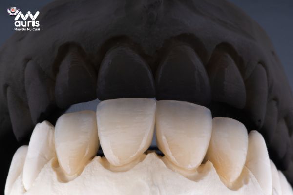 Ưu điểm của răng sứ cercon