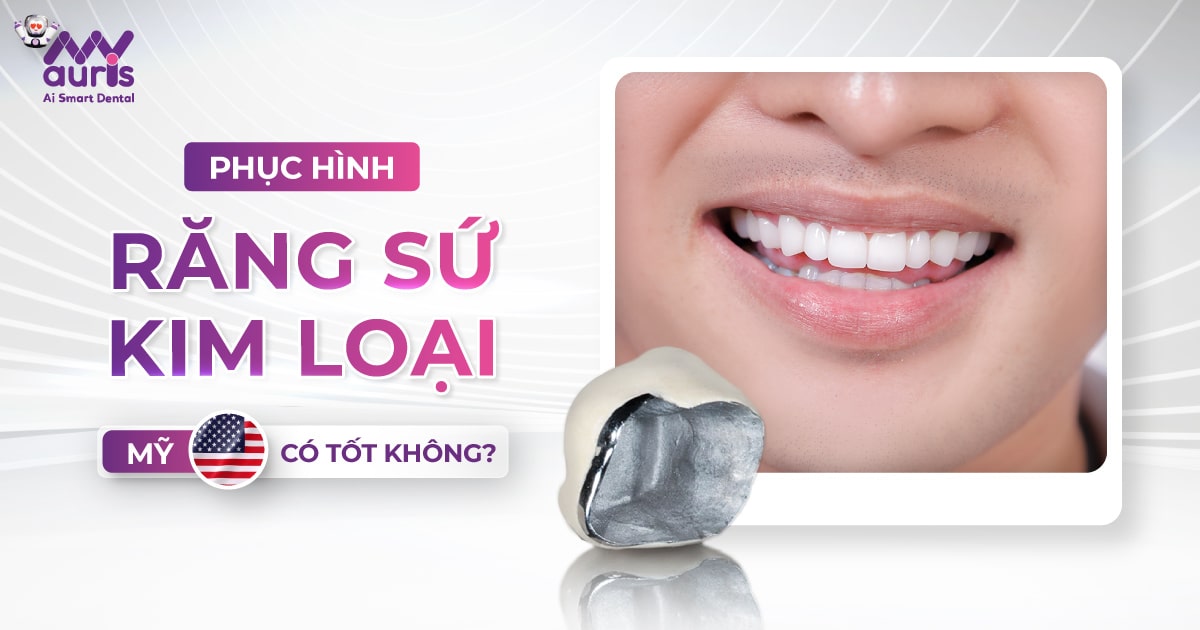 răng sứ kim loại mỹ