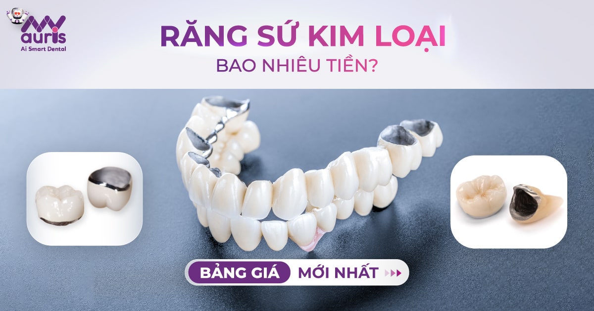 răng sứ kim loại giá bao nhiêu