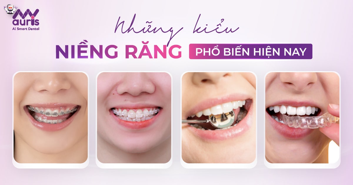 những kiểu niềng răng