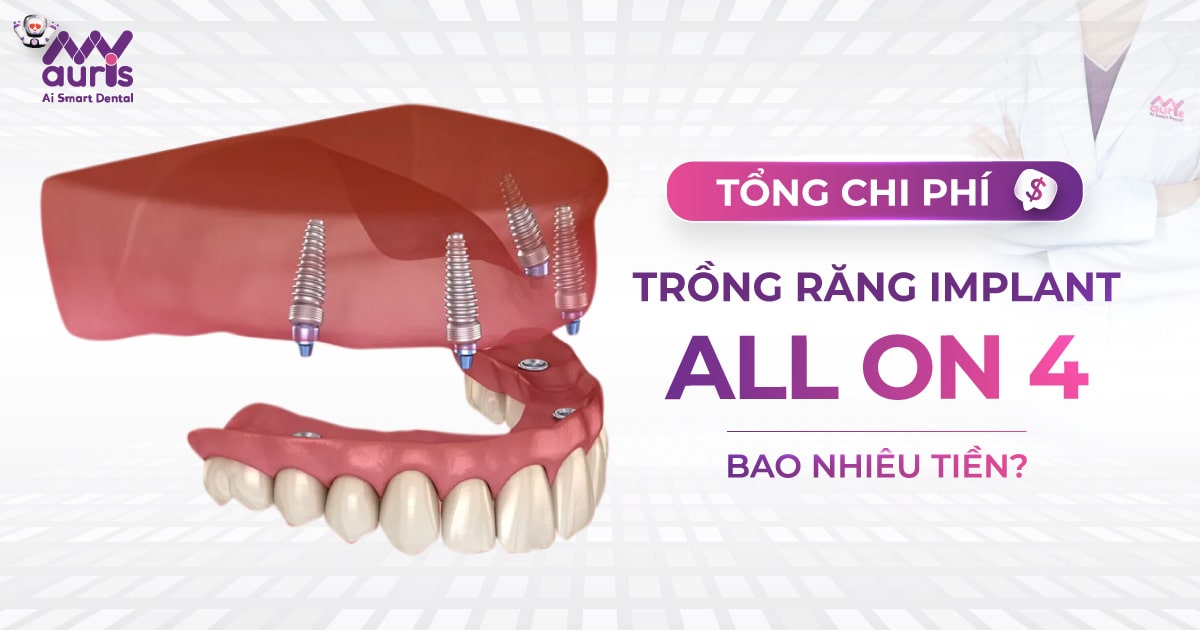 trồng răng implant all on 4 giá bao nhiêu