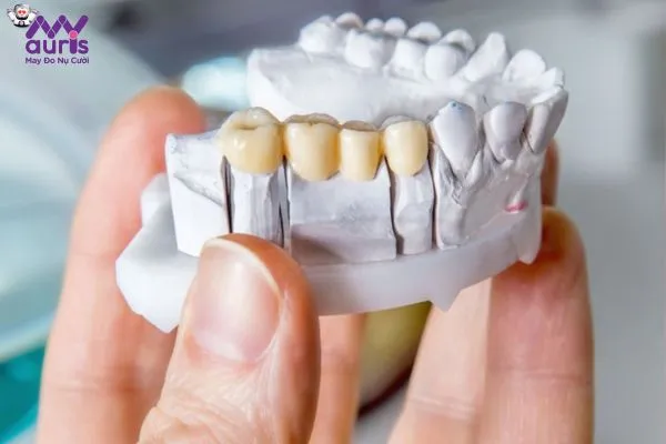 Các loại răng sứ thẩm mỹ - Răng sứ kim loại