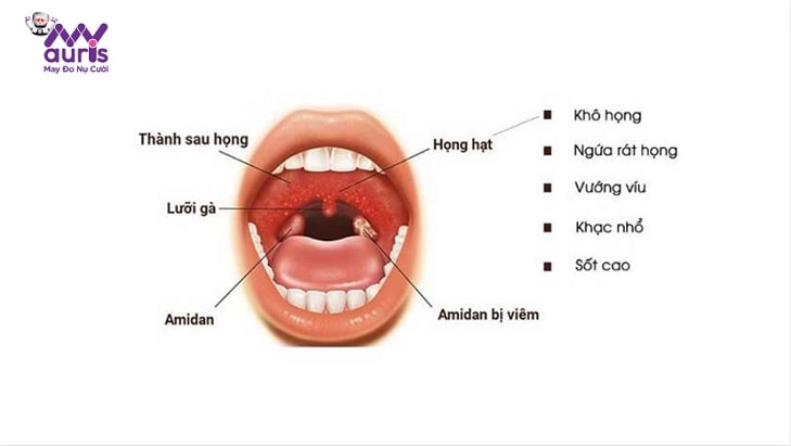 cách chữa viêm họng hạt bằng dân gian