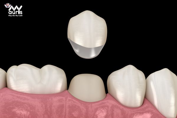 Tìm hiểu về phương pháp làm răng sứ 