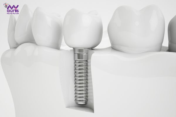 Giá trồng răng implant hàn quốc 