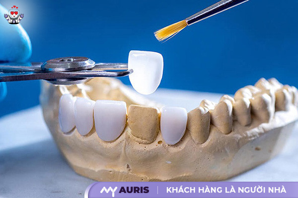 bọc răng sứ,làm răng sứ,công nghệ bọc răng sứ,công nghệ làm răng sứ,công nghệ răng sứ