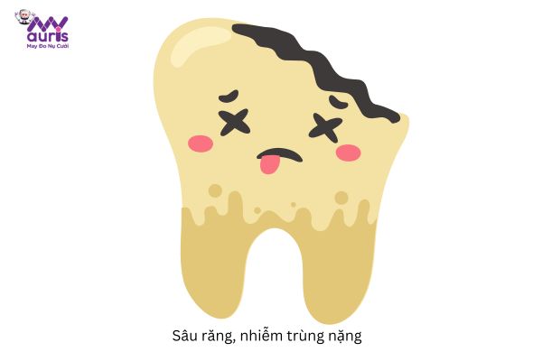 Lấy tủy khi răng bị sâu nặng 