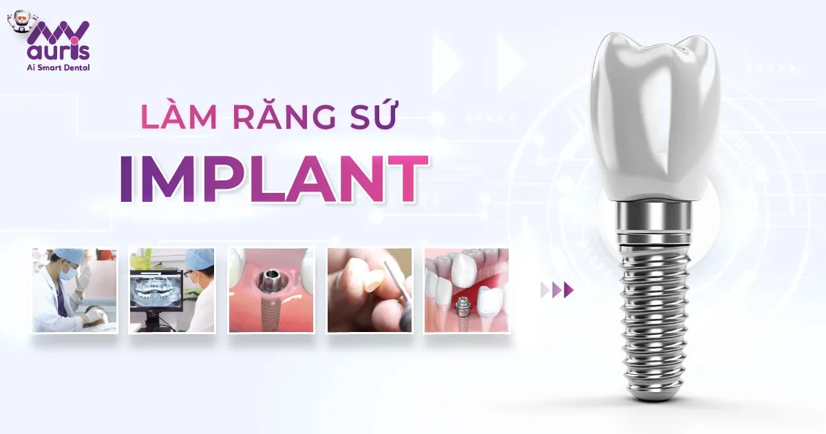 Làm răng sứ Implant - 6 bước thực hiện