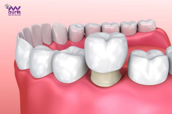 Làm răng sứ mỹ là gì?