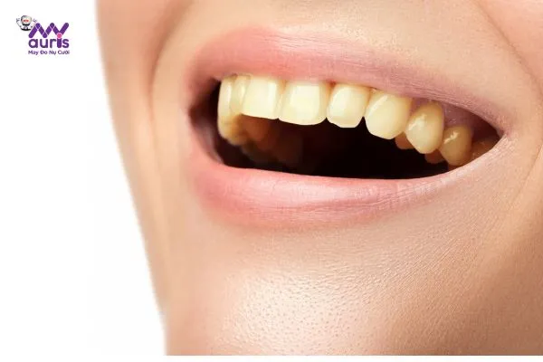 Răng ố vàng, nhiễm màu - Làm răng sứ cải thiện thẩm mỹ 