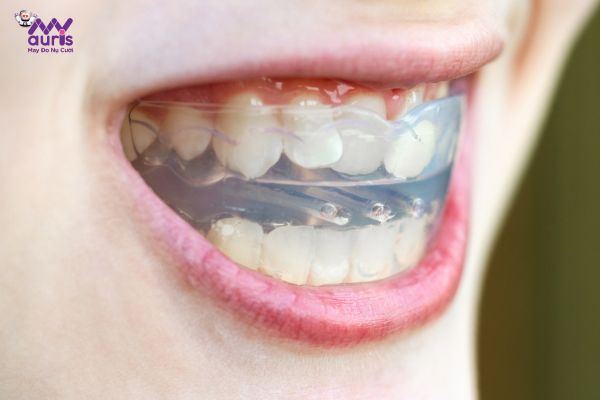 Lệch nhân trung khi niềng răng có chỉnh lại được không? 