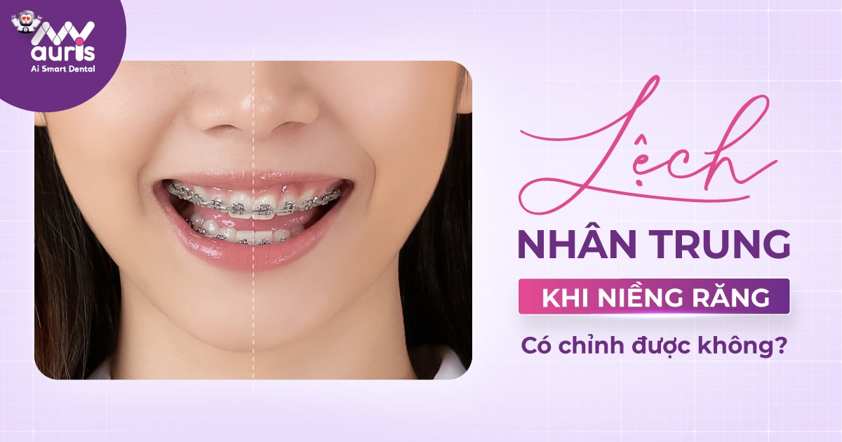 Lệch nhân trung khi niềng răng có chỉnh được không?