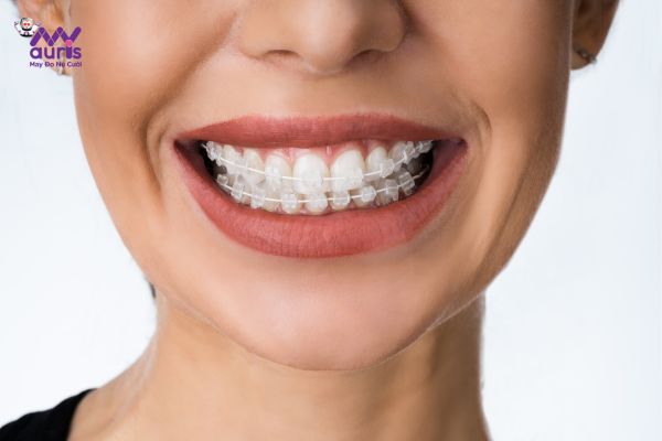 Giai đoạn 1 : Làm thẳng răng - lộ trình niềng răng 
