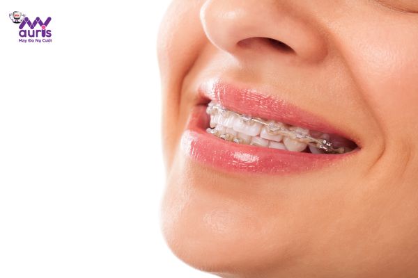 Giai đoạn 3: Đóng khoảng trong niềng răng - lộ trình niềng răng 