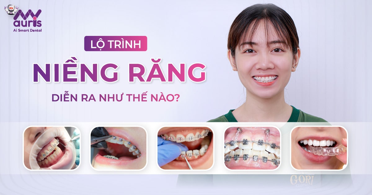 Lộ trình niềng răng diễn ra như thế nào?