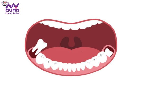 Nhận biết một số dấu hiệu đau răng khôn