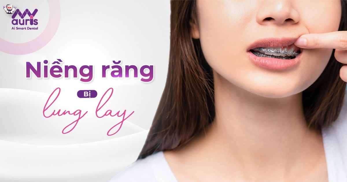 Niềng răng bị lung lay - 6 nguyên nhân cần chú ý