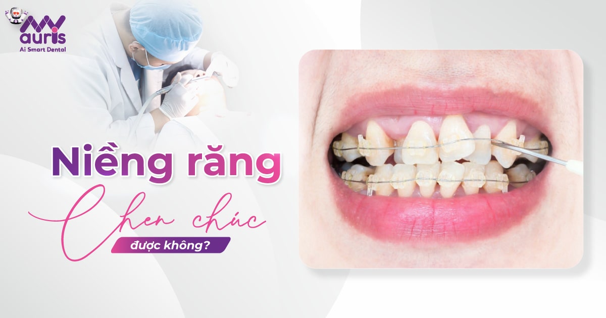 Niềng răng chen chúc - 3 yếu tố ảnh hưởng kết quả