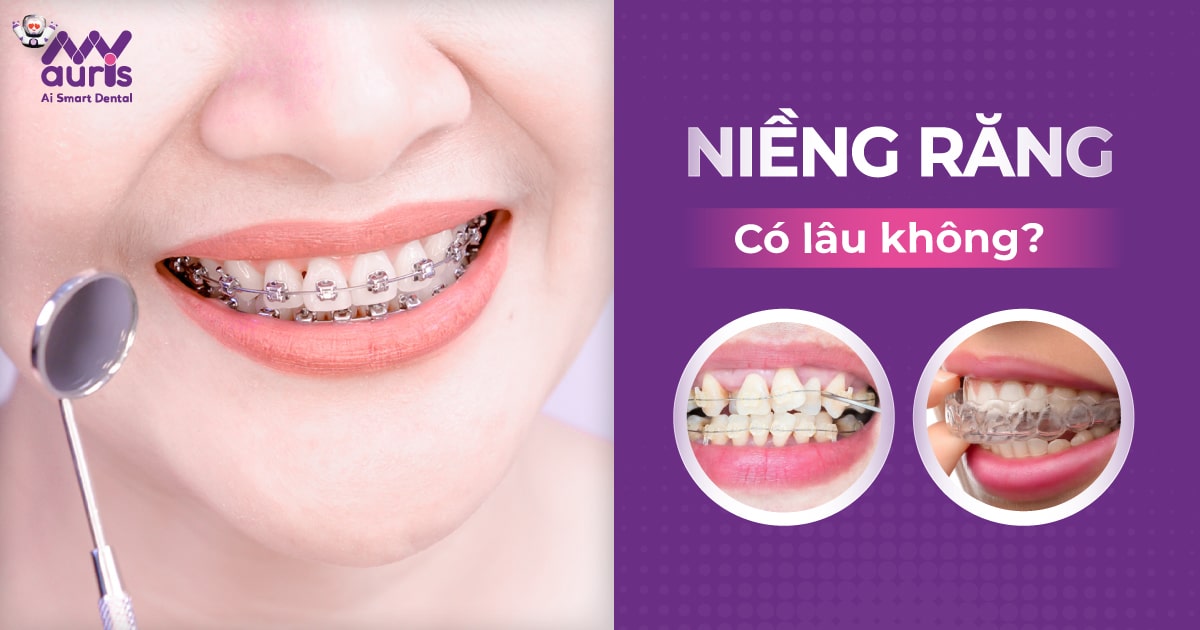 Niềng răng có lâu không? (Thực tế 6 giai đoạn chính)