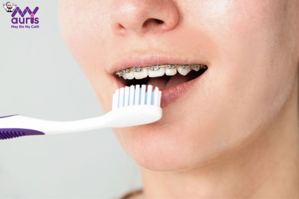 Hướng dẫn quá trình chăm sóc răng miệng khi đang niềng răng chỉnh nha