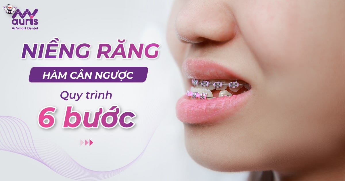 6 bước quy trình niềng răng hàm cắn ngược cần biết