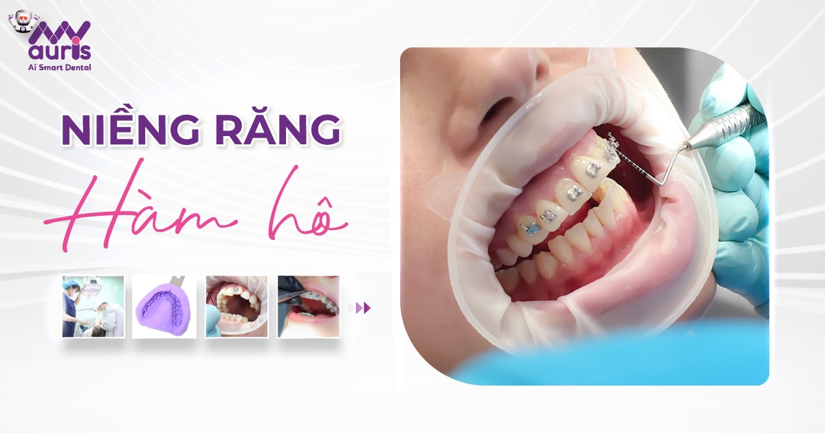 Niềng răng hàm hô - quy trình 5 bước thực hiện an toàn