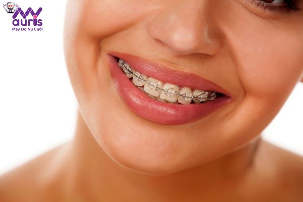 Niềng răng móm có cần phải nhổ răng không?