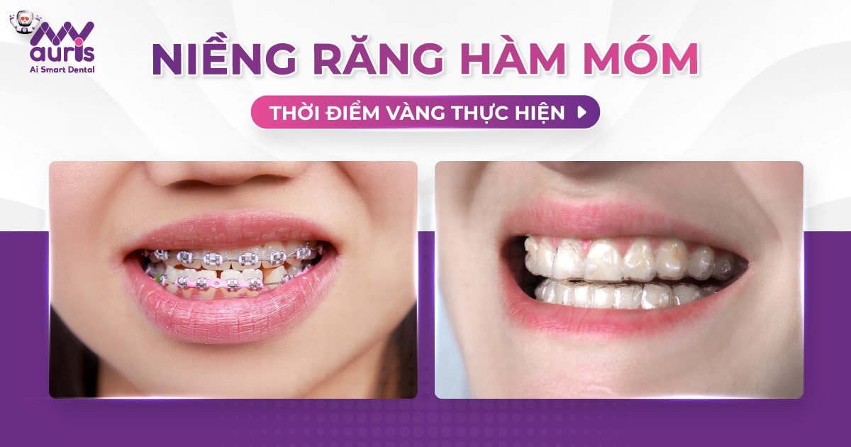 Thời điểm vàng niềng răng hàm móm cho 2 đối tượng chính