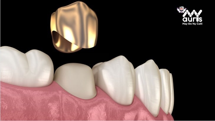 răng sứ kim loại quý
