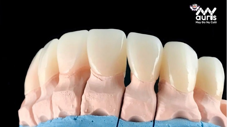 răng sứ kim loại titan có tốt không
