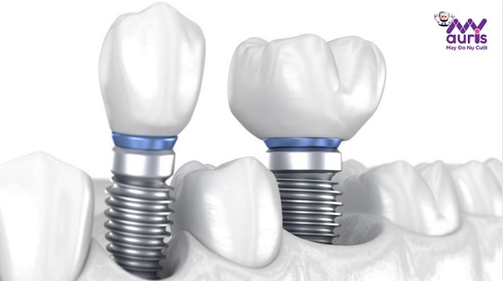 tại sao phải trồng răng implant