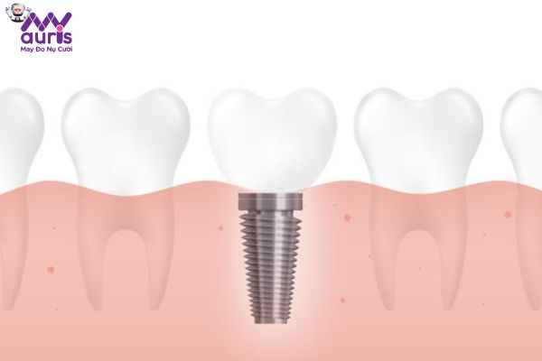 Trồng răng Implant sau bao lâu thì ăn uống được?