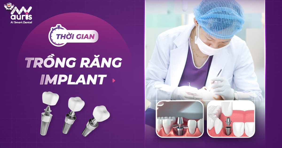 Thời gian trồng răng Implant - Chi tiết 2 giai đoạn