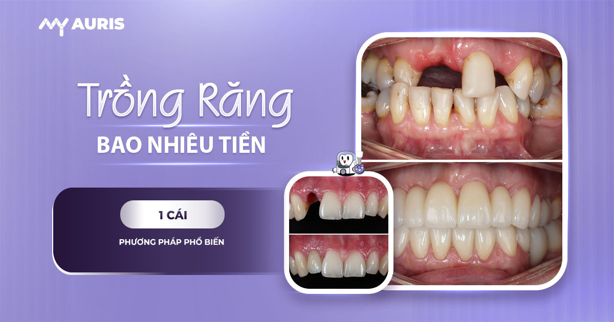 trồng 1 răng giá bao nhiêu,trồng 1 răng bao nhiêu tiền