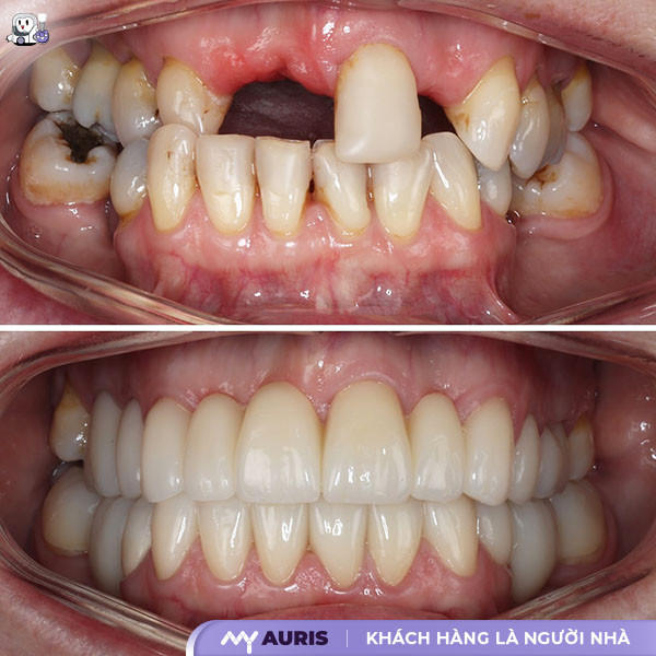 quy trình trồng răng implant chuẩn y khoa