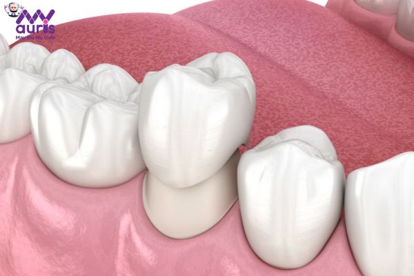 "Trồng răng bị gãy" với phương pháp bọc răng sứ