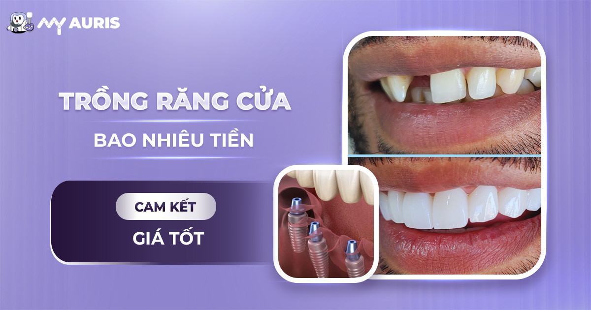 trồng răng cửa bao nhiêu tiền,chi phí trồng 1 răng cửa,trồng 1 răng cửa bao nhiêu tiền,trồng răng cửa hết bao nhiêu tiền