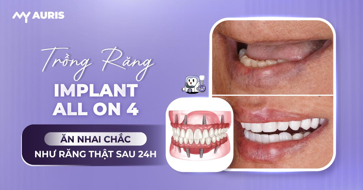 trồng răng implant all on 4,all on 4