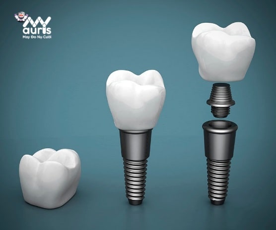 trồng răng implant bao lâu thì lành