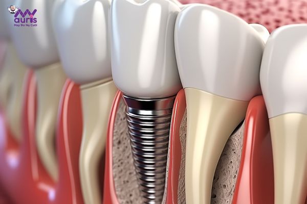 Trồng răng implant giữ được bao lâu? 