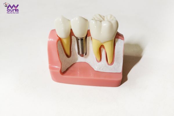 Trồng răng implant mất bao lâu?