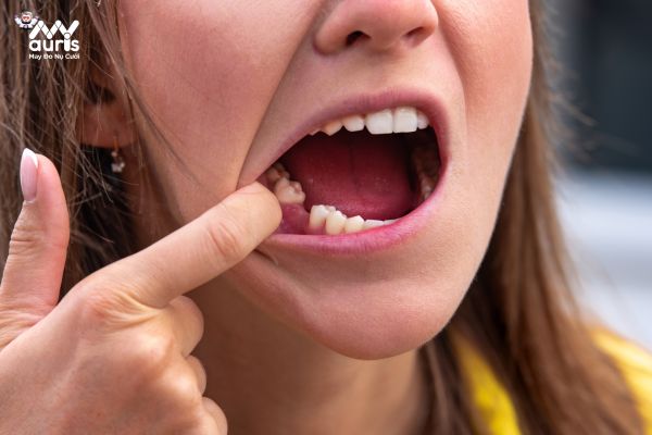 Tình trạng mất răng - Trồng răng implant mất bao lâu phụ thuộc yếu tố nào?
